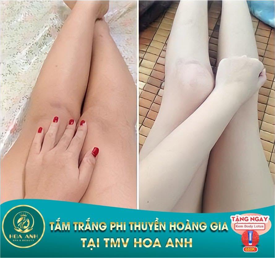 Trước và sau tắm trắng Phi Thuyền Hoàng Gia vùng chân tại Hoa Anh